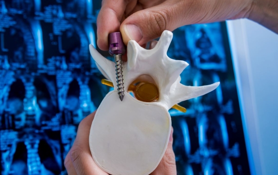 sistemas-de-fijación-de-columna-vertebral sistemas-de-fijación-de-columna-vertebral
