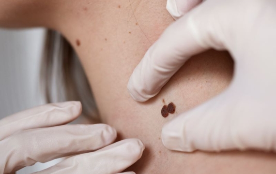 diagnosticando-melanoma