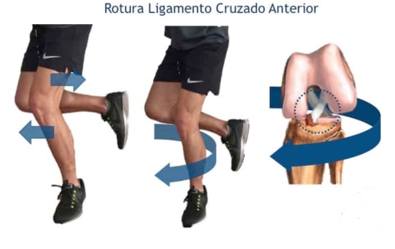 Recuperación del ligamento cruzado anterior - DR BALLESTER- TRAUMATOLOGIA  CIRUGIA ORTOPEDICA