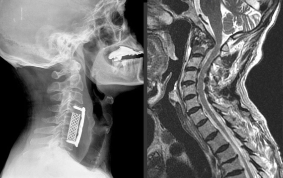 cirugia-cervical-valencia