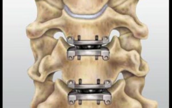 cirugia-cervical-valencia