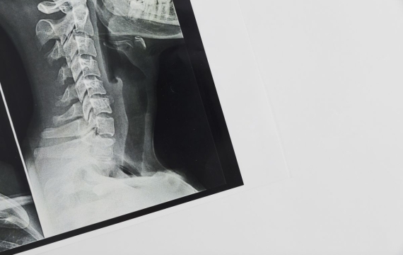 cirugia-cervical-valencia