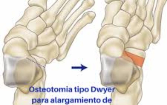 osteotomía-de-alineación