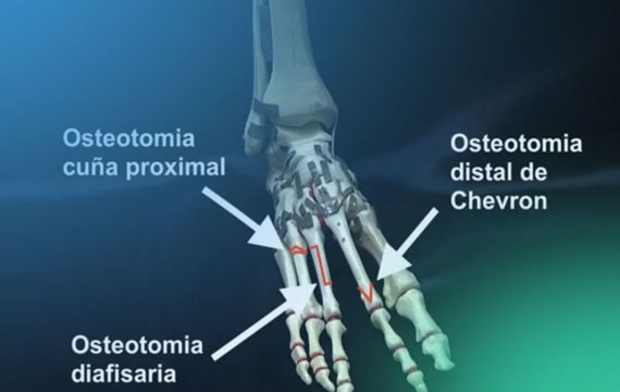 tipos-osteotomía-valencia