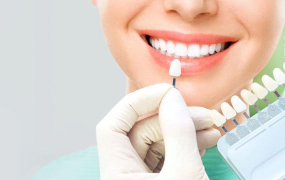 blanqueamiento-dental-valencia blanqueamiento-dental-valencia
