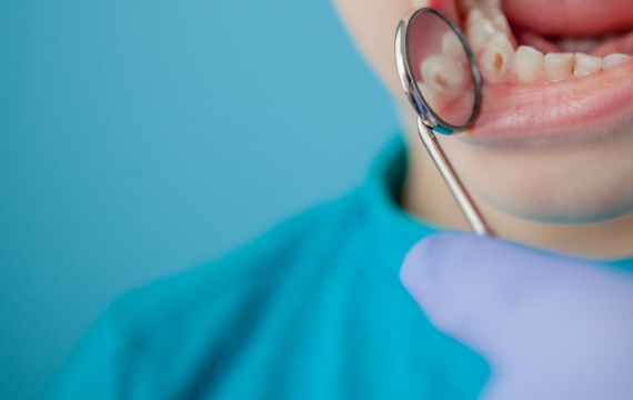 caries caries