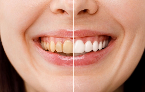 manchas-en-dientes-valencia manchas-en-dientes-valencia