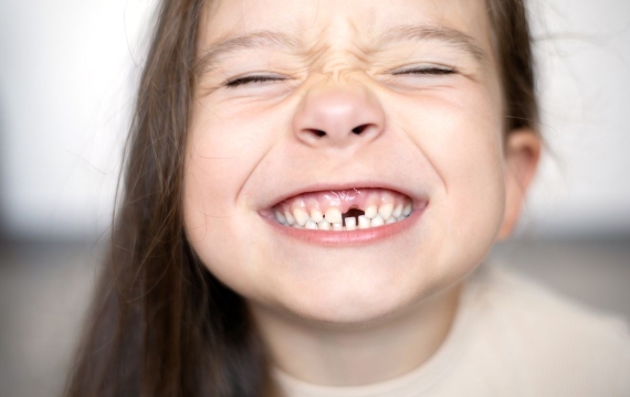 dientes-fracturados dientes-fracturados