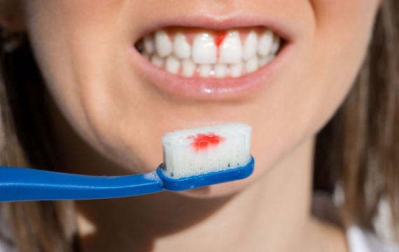 sangrado-dientes sangrado-dientes