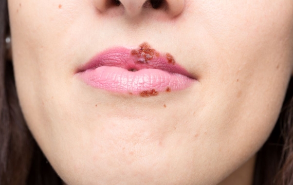 herpes-valencia herpes-valencia