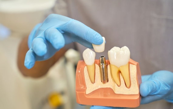 tipos de implantes tipos de implantes