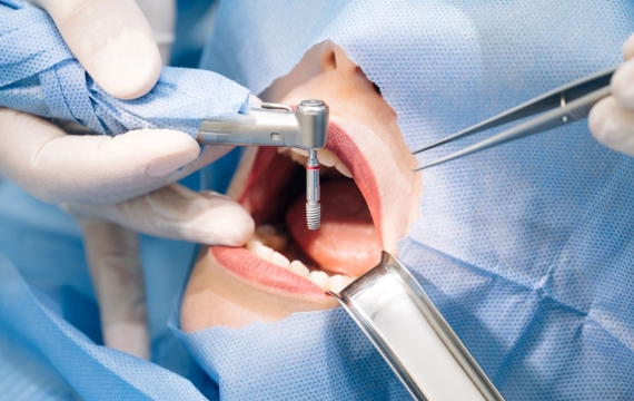 colación-implante-dental colación-implante-dental
