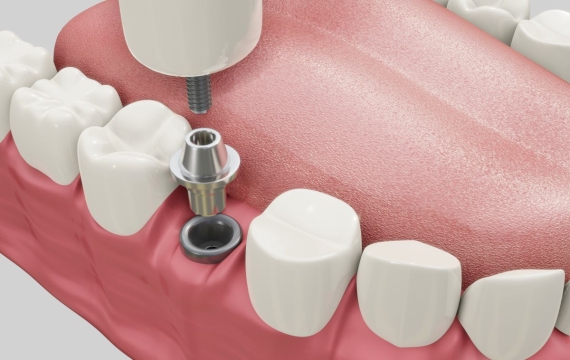 tratamiento-implantes tratamiento-implantes