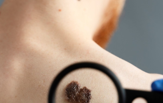 melanomas melanomas