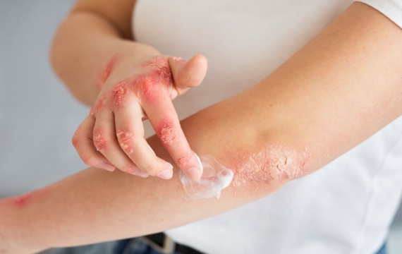 tratamiento-psoriasis tratamiento-psoriasis