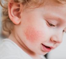Dermatología Infantil en valencia Dermatología Infantil en Valencia