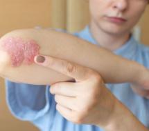 Unidad De Psoriasis en Valencia Unidad De Psoriasis en Valencia