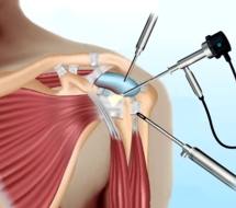 Cirugía-Artroscopia-de-Hombro-Valencia