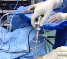 Artroscopia-de-tobillo-Valencia