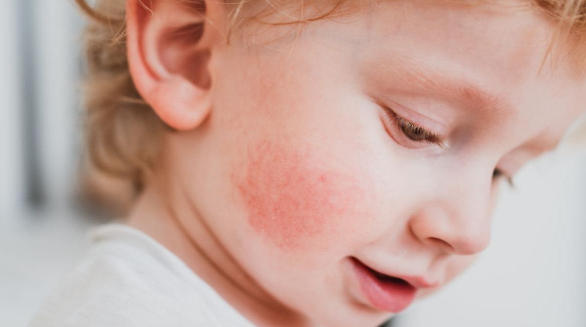 Dermatología Infantil en valencia Dermatología Infantil en Valencia