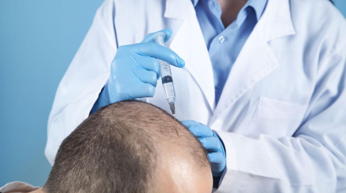 Unidad De Alopecia E Injerto Capilar en Valencia Unidad De Alopecia E Injerto Capilar en Valencia