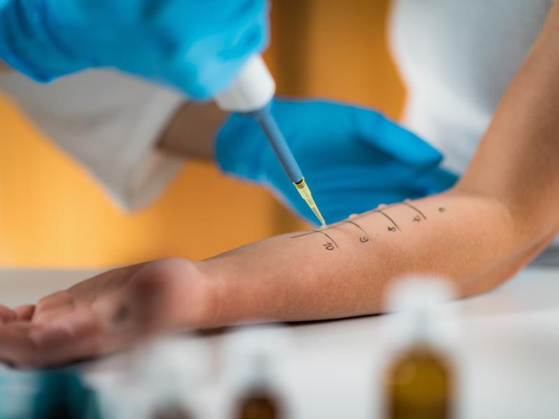 Pruebas cutáneas en valencia Pruebas alergicas