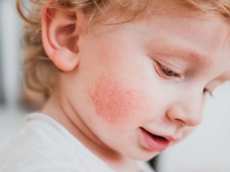 Dermatología Infantil en valencia Dermatología Infantil en Valencia
